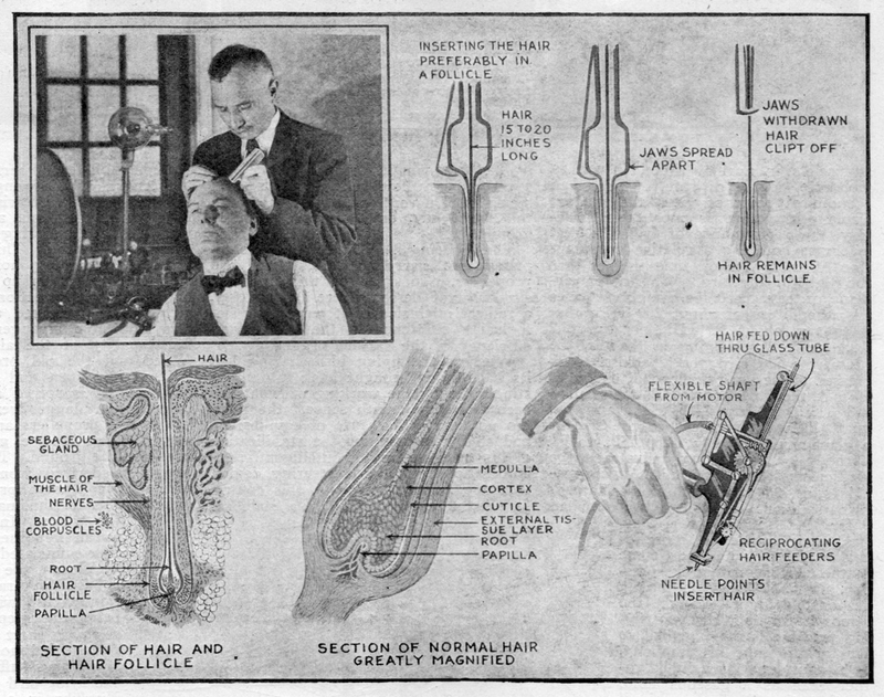 Illustration for article titled The First Hair Plug Machine Looks Absolutely Horrifying
